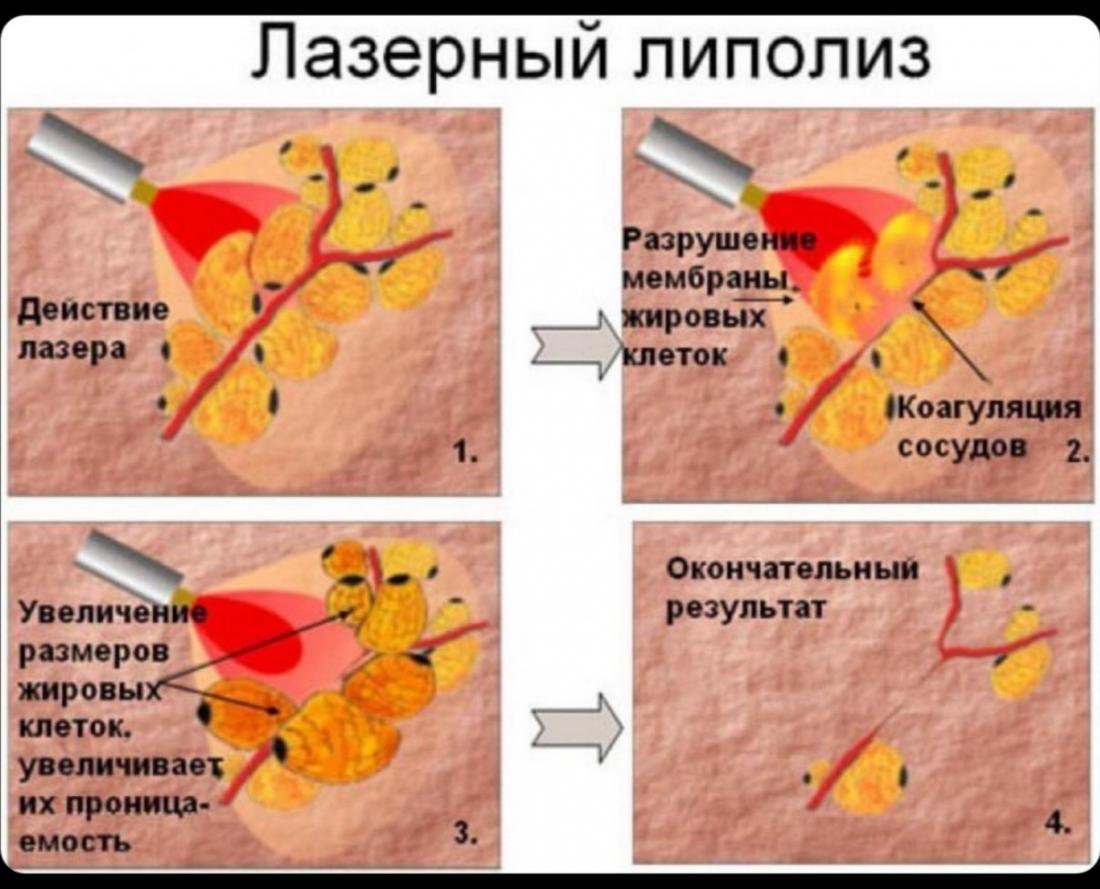 Лазерный липолиз